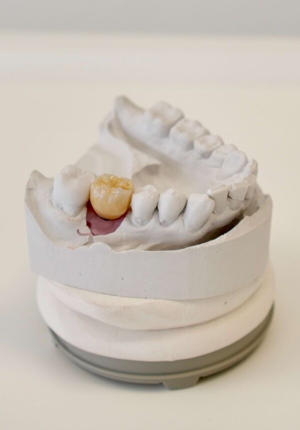 Nahaufnahme eines Kiefermodells mit Zahnersatz.